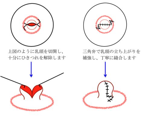 陥没乳首 男|陥没乳頭（陥没乳首）を男女とも放置してはいけない3つのワケ…